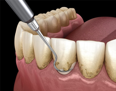 A Patient's Guide to Dental Deep Cleanings