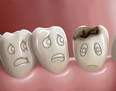 Cavities-or-tooth-decay