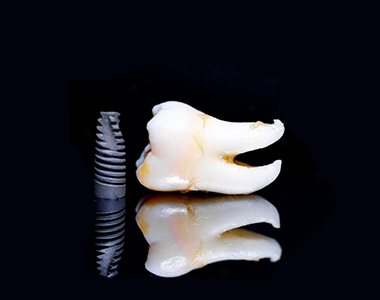 zygomatic-implants