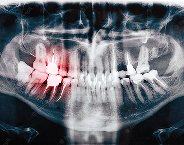 Dental-x-ray