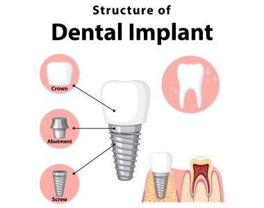 Dental Implants Fremont Ohio